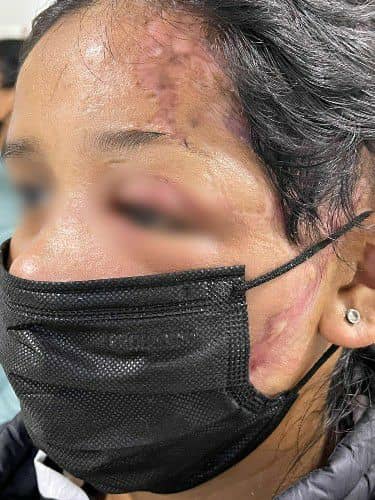 Reconstrucción Facial - Cirujano Maxilofacial Santa Cruz - Centro de Cirugía Bucal y Traumatología Maxilofacial en Bolivia2