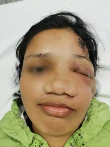 Reconstrucción Facial - Cirujano Maxilofacial Santa Cruz - Centro de Cirugía Bucal y Traumatología Maxilofacial en Bolivia3