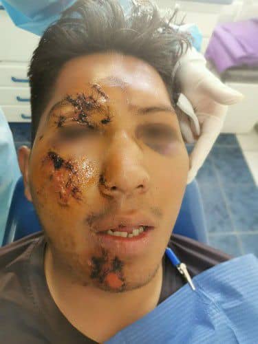 Reconstruccion de politrauma facial - Centro de Cirugía Bucal y Traumatología Maxilofacial Bolivia 1