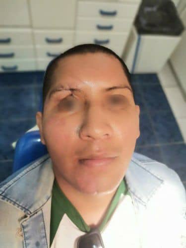 Reconstruccion de politrauma facial - Centro de Cirugía Bucal y Traumatología Maxilofacial Bolivia
