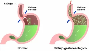 Reflujo Gastroesofágico (Laparoscópica) Dr. Roberto Aguirre Michel Cirujano General Sucre