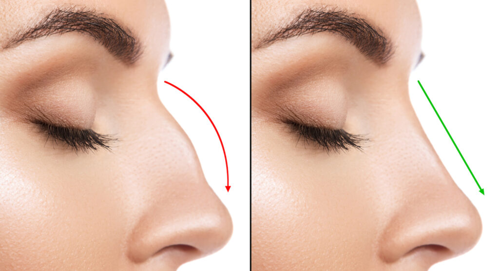Rinoplastia - Dr. Diego Armando Morejon Cirujano Plastico Cochabamba