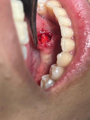 Sialolito o Cálculo Salival Centro de Cirugía Bucal y Traumatología Maxilofacial en Bolivia
