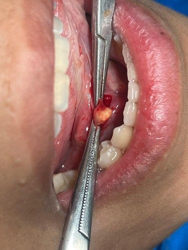 Sialolito o Cálculo Salival Centro de Cirugía Bucal y Traumatología Maxilofacial en Bolivia