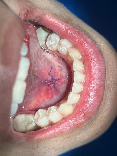 Sialolito o Cálculo Salival Centro de Cirugía Bucal y Traumatología Maxilofacial en Bolivia
