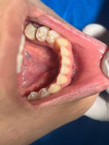 Sialolito o Cálculo Salival Centro de Cirugía Bucal y Traumatología Maxilofacial en Bolivia