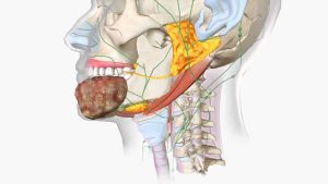 Sobrevida Post Cirugía y Radioterapia con Quimioterapia en Pacientes con Cáncer Oral Centro de Cirugía Bucal y Traumatología Maxilofacial en Bolivia