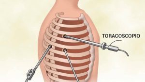 Toracoscopia en el diagnóstico y tratamiento de la endometriosis torácica - Dr. Edwin E. Marmol Cazas - Cirujano Torácico - Cochabamba