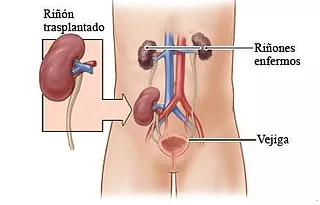Trasplante Renal - Dr. Israel Rivas Nefrologo Cochabamba 1