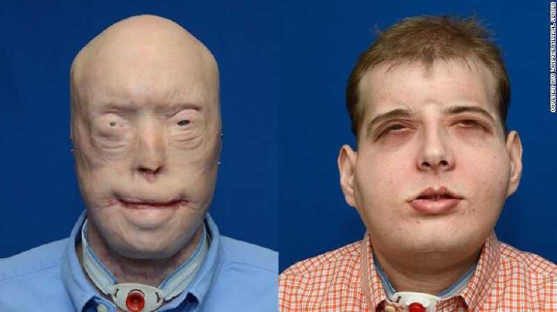 Trasplante Facial en Boliva - Centro de Cirugía Bucal y Traumatología Maxilofacial en Bolivia