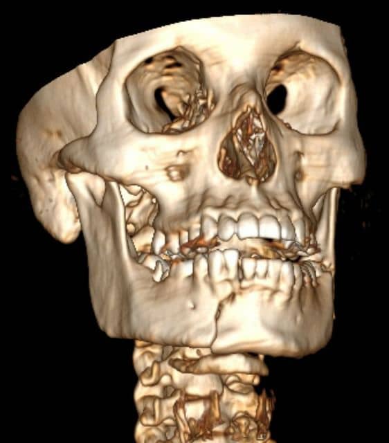 Tratamiento de Fracturas Mandibulares o de Maxilar Inferior Centro de Cirugía Bucal y Traumatología Maxilofacial en Bolivia