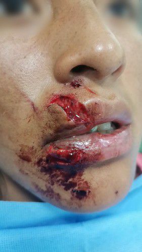Trauma Facial, Cortes en el Rostro y Accidentes Centro de Cirugía Bucal y Traumatología Maxilofacial en Bolivia