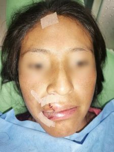 Trauma Facial, Cortes en el Rostro y Accidentes Centro de Cirugía Bucal y Traumatología Maxilofacial en Bolivia