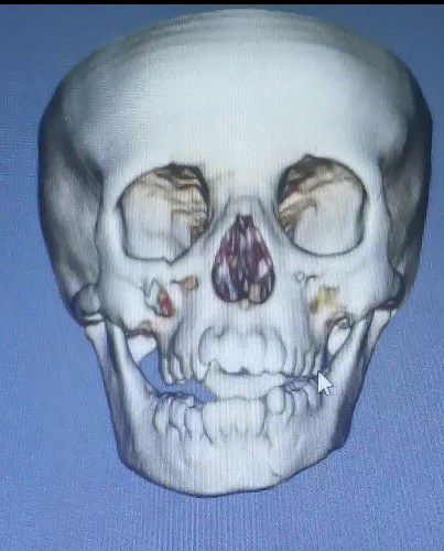 Trauma Facial y Fractura Mandibular en Niños Centro de Cirugía Bucal y Traumatología Maxilofacial en Bolivia