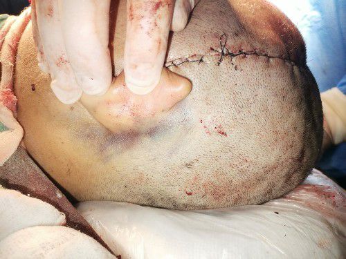 Traumas y Fracturas Cráneo Faciales Centro de Cirugía Bucal y Traumatología Maxilofacial en Bolivia