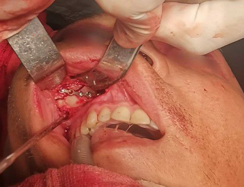 Traumas y Fracturas Cráneo Faciales Centro de Cirugía Bucal y Traumatología Maxilofacial en Bolivia