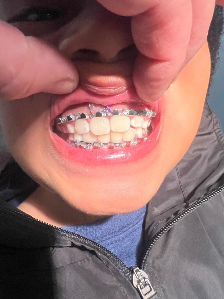 Traumatismo dental o dentoalveolar en niños Centro de Cirugia Maxilofacial