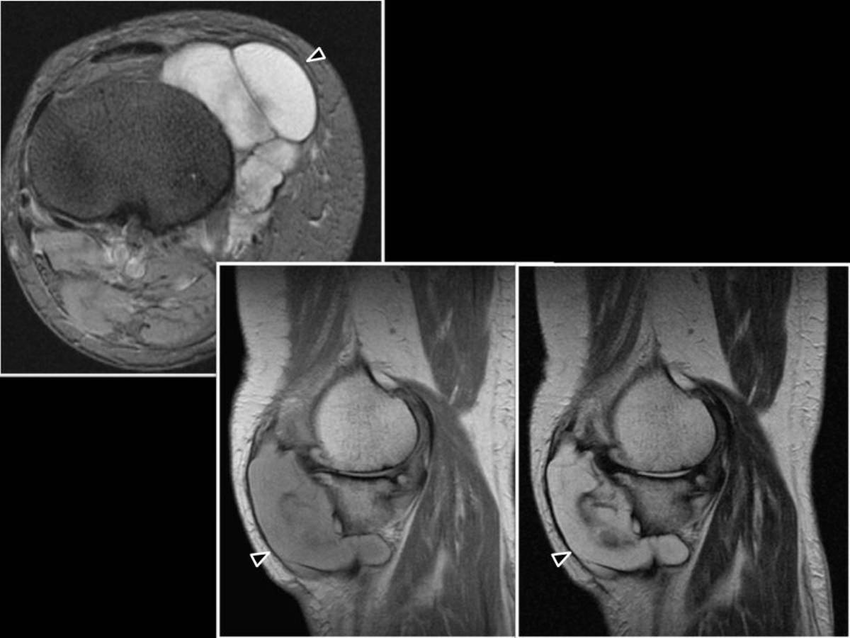Tumor Sinovial de la Rodilla Dr. Arnold Vergara Montan Traumatólogo Cochabamba