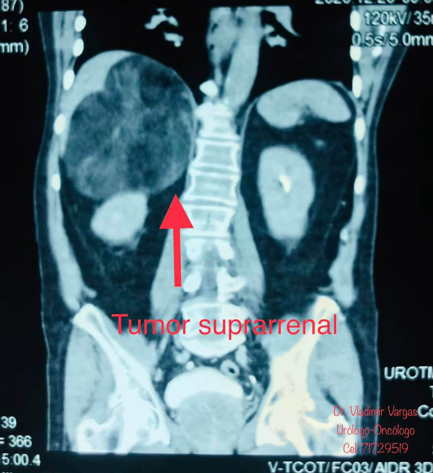 Tumor Suprarenal - Dr. Vladimir Vargas Urologo en Cochabamba