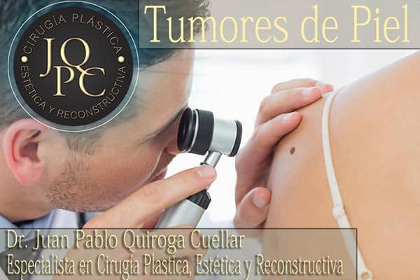 Tumores de Piel - Dr. Juan Pablo Quiroga Cuellar - Cirugía Plástica en Cochabamba