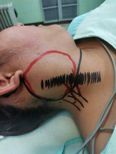 Tumores en el Cuello - Centro de Cirugía Bucal y Traumatología Maxilofacial en Cochabamba 1