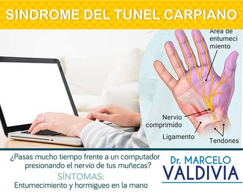Tunel Carpiano - Dr. Marcelo Valdivia Loza - Traumatólogo Ortopedista en cochabamba