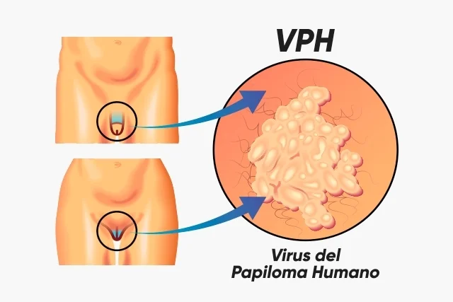 Virus del Papiloma Humano Dra. Alina Gallardo Sejas Cirujana General, Laparoscópica y Coloproctóloga Cochabamba