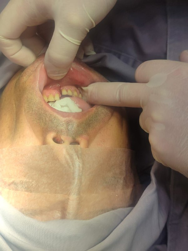 Fractura Facial por Accidente Automovilístico - Cirujano Maxilofacial Cochabamba - Centro de Cirugía Bucal y Traumatología Maxilofacial en Bolivia