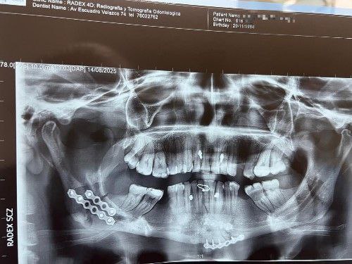 Fractura Facial por Accidente Automovilístico - Cirujano Maxilofacial Cochabamba - Centro de Cirugía Bucal y Traumatología Maxilofacial en Bolivia