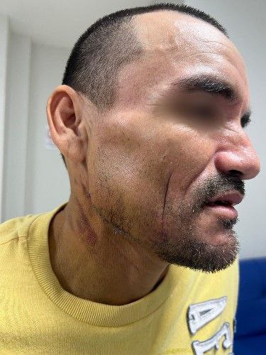 Fractura Facial por Accidente Automovilístico - Cirujano Maxilofacial Cochabamba - Centro de Cirugía Bucal y Traumatología Maxilofacial en Bolivia