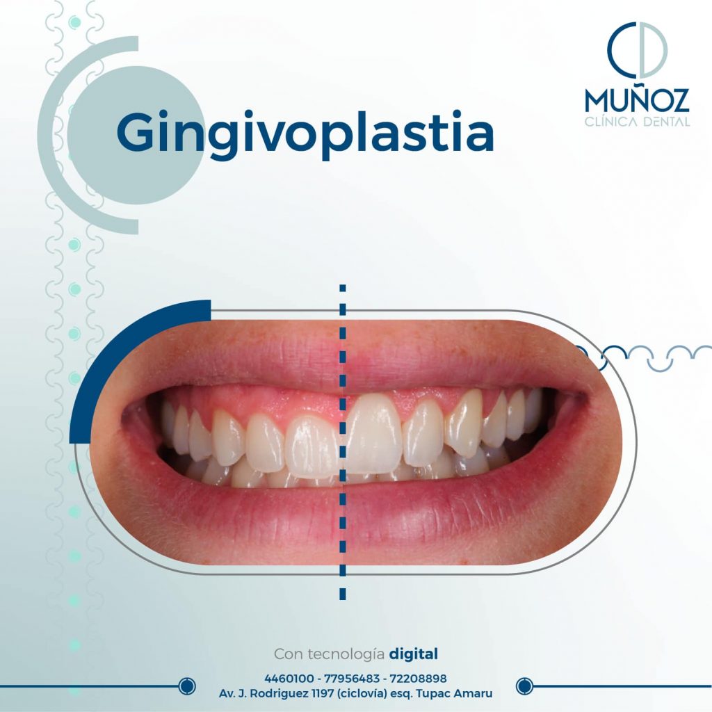 gingivoplastia - Clínica Dental Muñoz Cochabamba