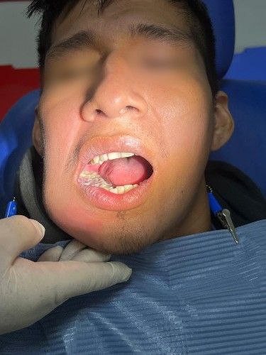 Cáncer Bucal en Pacientes Jóvenes - Cirujano Maxilofacial Cochabamba - Centro de Cirugía Bucal y Traumatología Maxilofacial en Bolivia