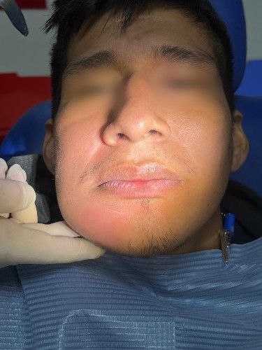 Cáncer Bucal en Pacientes Jóvenes - Cirujano Maxilofacial Cochabamba - Centro de Cirugía Bucal y Traumatología Maxilofacial en Bolivia