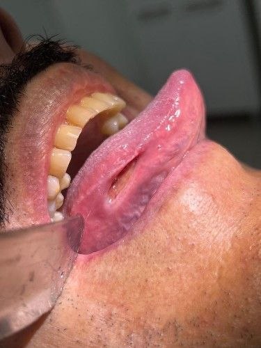 Cáncer Bucal Centro de Cirugía Bucal y Traumatología Maxilofacial en Bolivia