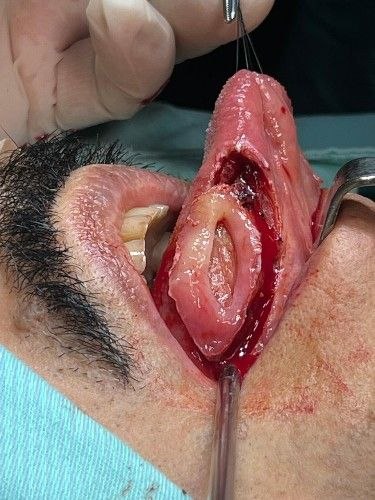 Cáncer Bucal Centro de Cirugía Bucal y Traumatología Maxilofacial en Bolivia