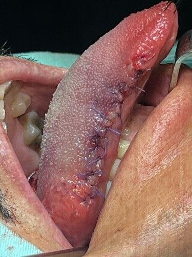Cáncer Bucal Centro de Cirugía Bucal y Traumatología Maxilofacial en Bolivia