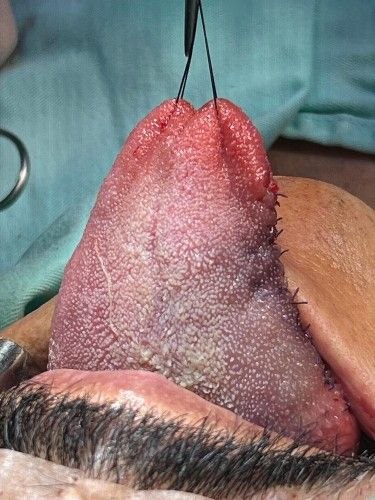 Cáncer Bucal Centro de Cirugía Bucal y Traumatología Maxilofacial en Bolivia