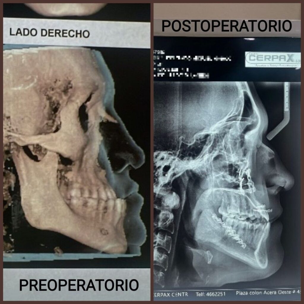 Cirugía Ortognática Bolivia - Corrección de la Mordida Centro de Cirugía y Traumatología Maxilofacial Bolivia