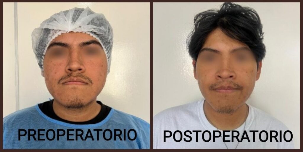 Cirugía Ortognática Bolivia - Corrección de la Mordida Centro de Cirugía y Traumatología Maxilofacial Bolivia