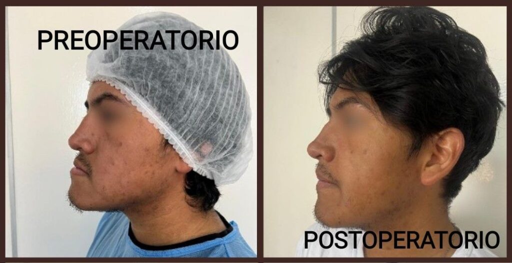 Cirugía Ortognática Bolivia - Corrección de la Mordida Centro de Cirugía y Traumatología Maxilofacial Bolivia