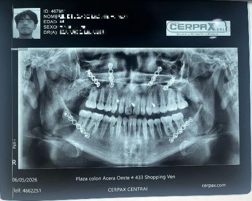 Cirugía Ortognática Bolivia - Corrección de la Mordida Centro de Cirugía y Traumatología Maxilofacial Bolivia
