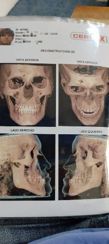 Cirugía Ortognática Bolivia - Corrección de la Mordida Centro de Cirugía y Traumatología Maxilofacial Bolivia