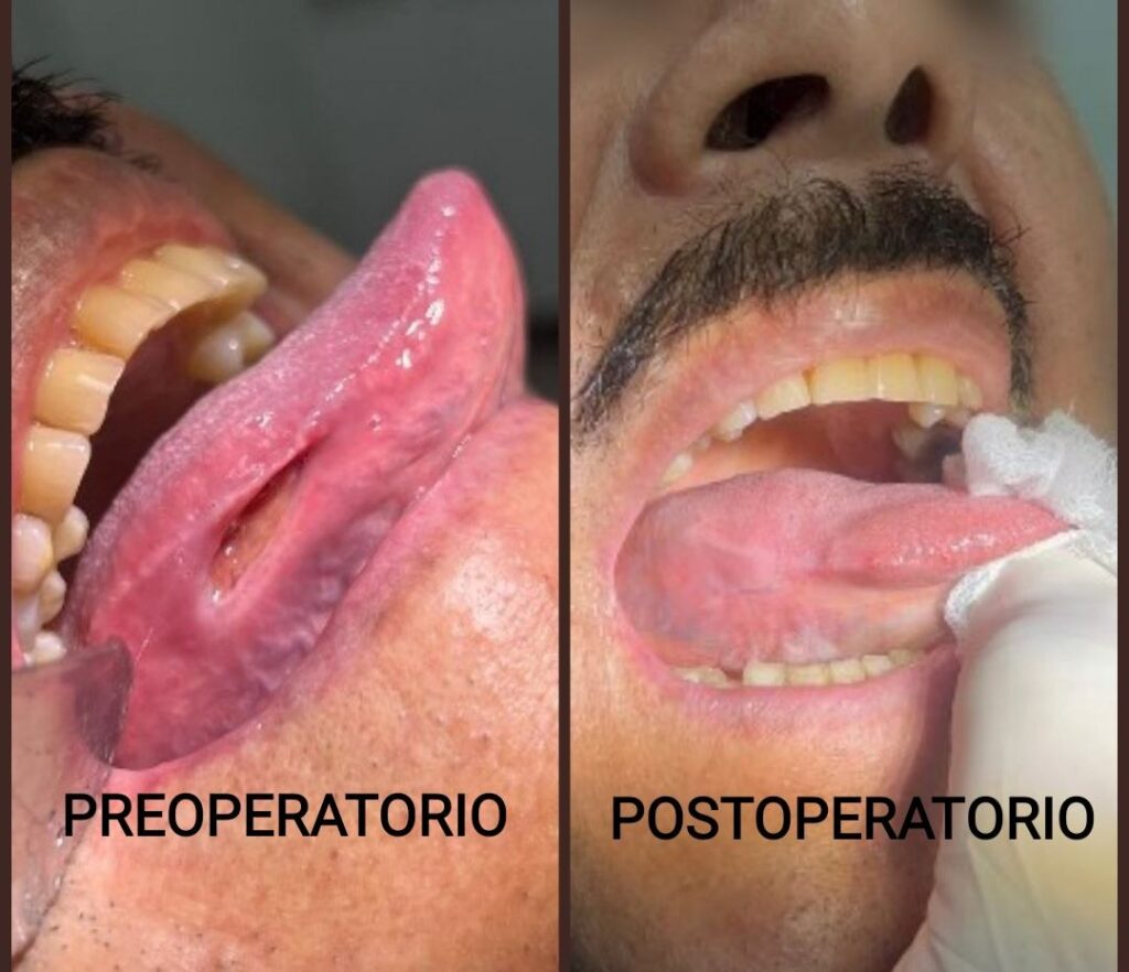 Cáncer Bucal Centro de Cirugía Bucal y Traumatología Maxilofacial en Bolivia