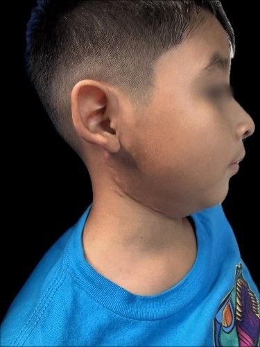 Tumores de la Glándula Parotídea - Cirujano Maxilofacial - Centro de Cirugía y Traumatología Maxilofacial Bolivia