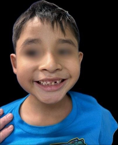 Tumores de la Glándula Parotídea - Cirujano Maxilofacial - Centro de Cirugía y Traumatología Maxilofacial Bolivia