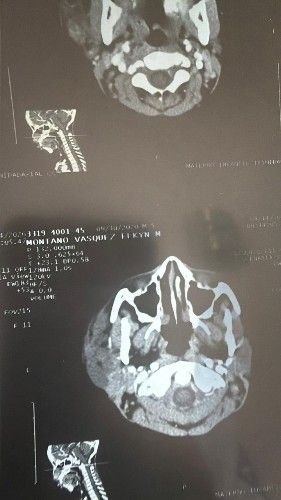 Tumores de la Glándula Parotídea - Cirujano Maxilofacial - Centro de Cirugía y Traumatología Maxilofacial Bolivia