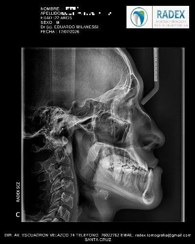 Cirugía Ortognática Mínimamente Invasiva y Convencional - Cirujano Maxilofacial - Centro de Cirugía y Traumatología Maxilofacial Bolivia