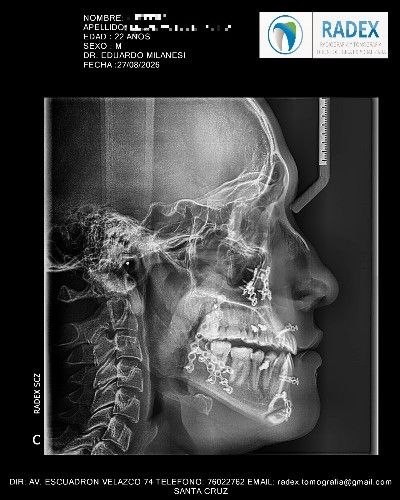 Cirugía Ortognática Mínimamente Invasiva y Convencional - Cirujano Maxilofacial - Centro de Cirugía y Traumatología Maxilofacial Bolivia