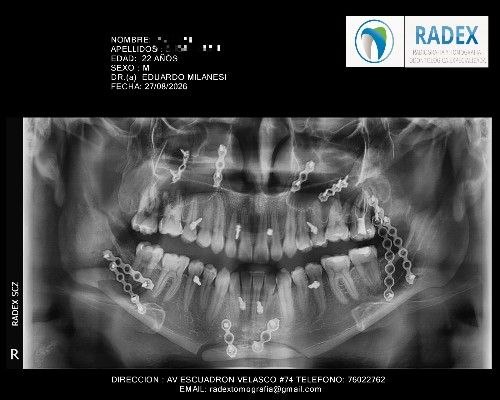 Cirugía Ortognática Mínimamente Invasiva y Convencional - Cirujano Maxilofacial - Centro de Cirugía y Traumatología Maxilofacial Bolivia