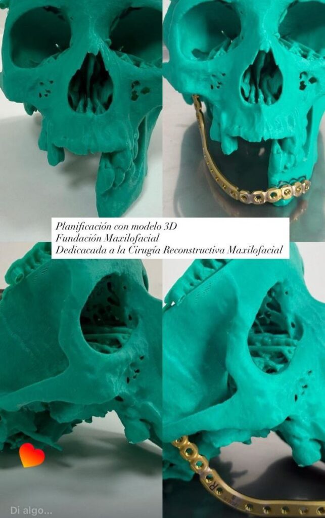 Injerto Libre de Peroné - Cirugía Maxilofacial - Cirujano Maxilofacial - Centro de Cirugía y Traumatología Maxilofacial Bolivia